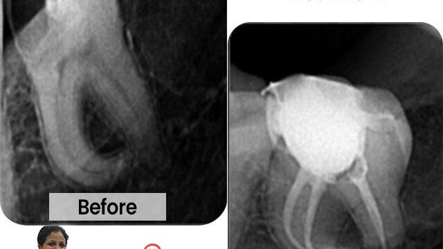 Dr.-Pawars-Advanced-Dentistry-root-canal-specialist-in-thane-west