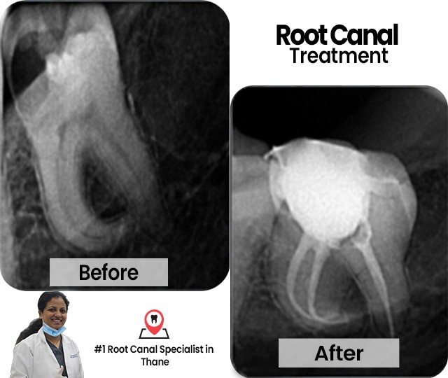 Dr.-Pawars-Advanced-Dentistry-root-canal-specialist-in-thane-west