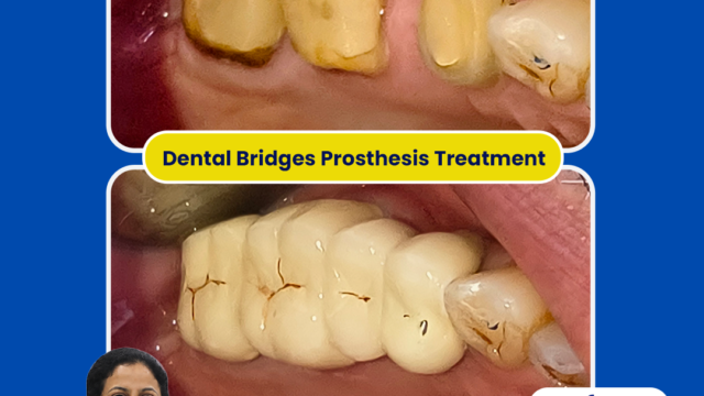 bridges-prosthesis-treatmentr