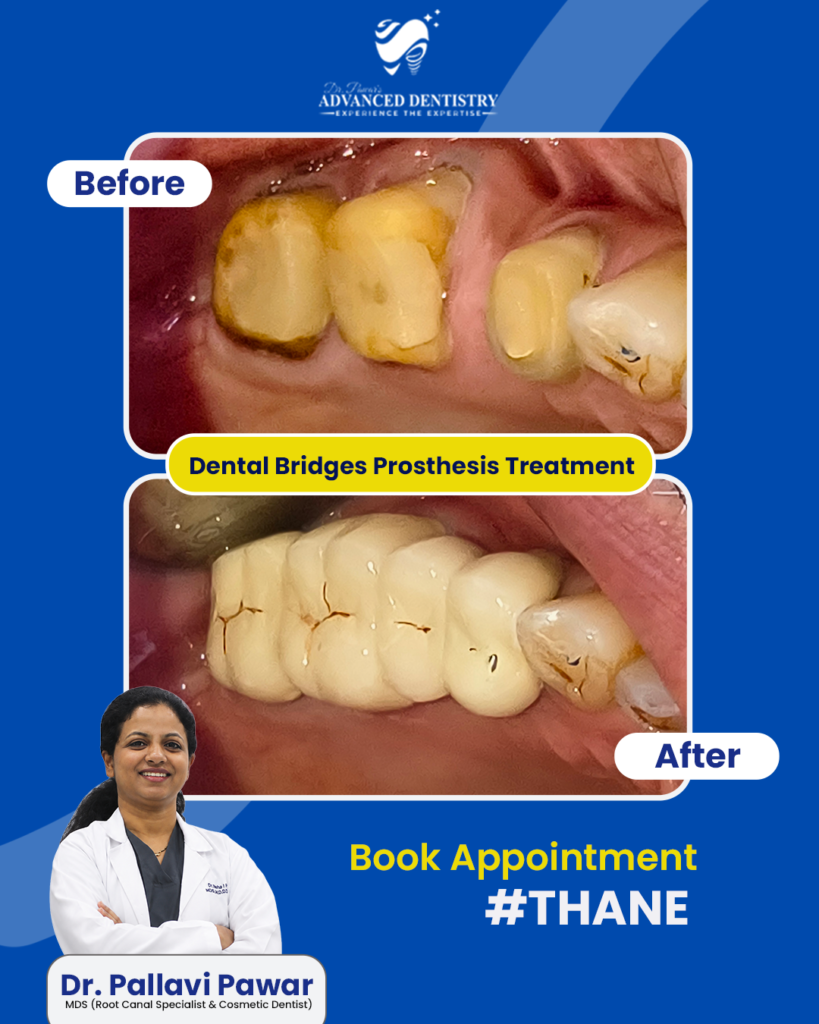 bridges-prosthesis-treatmentr